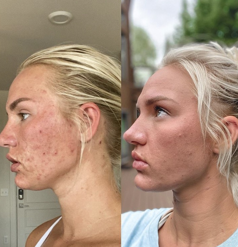 accutane before and after body