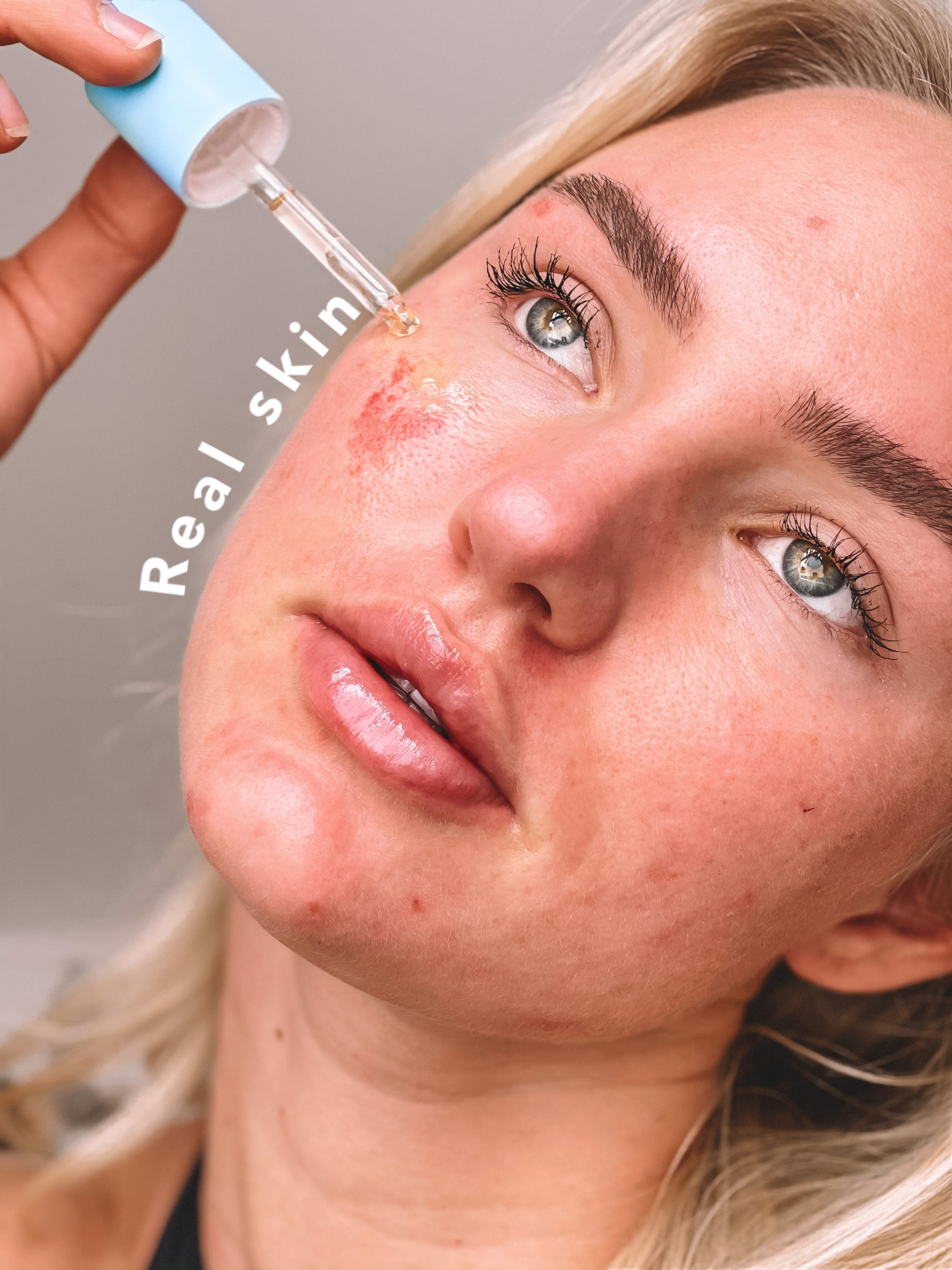 Everything You Need To Know About Accutane