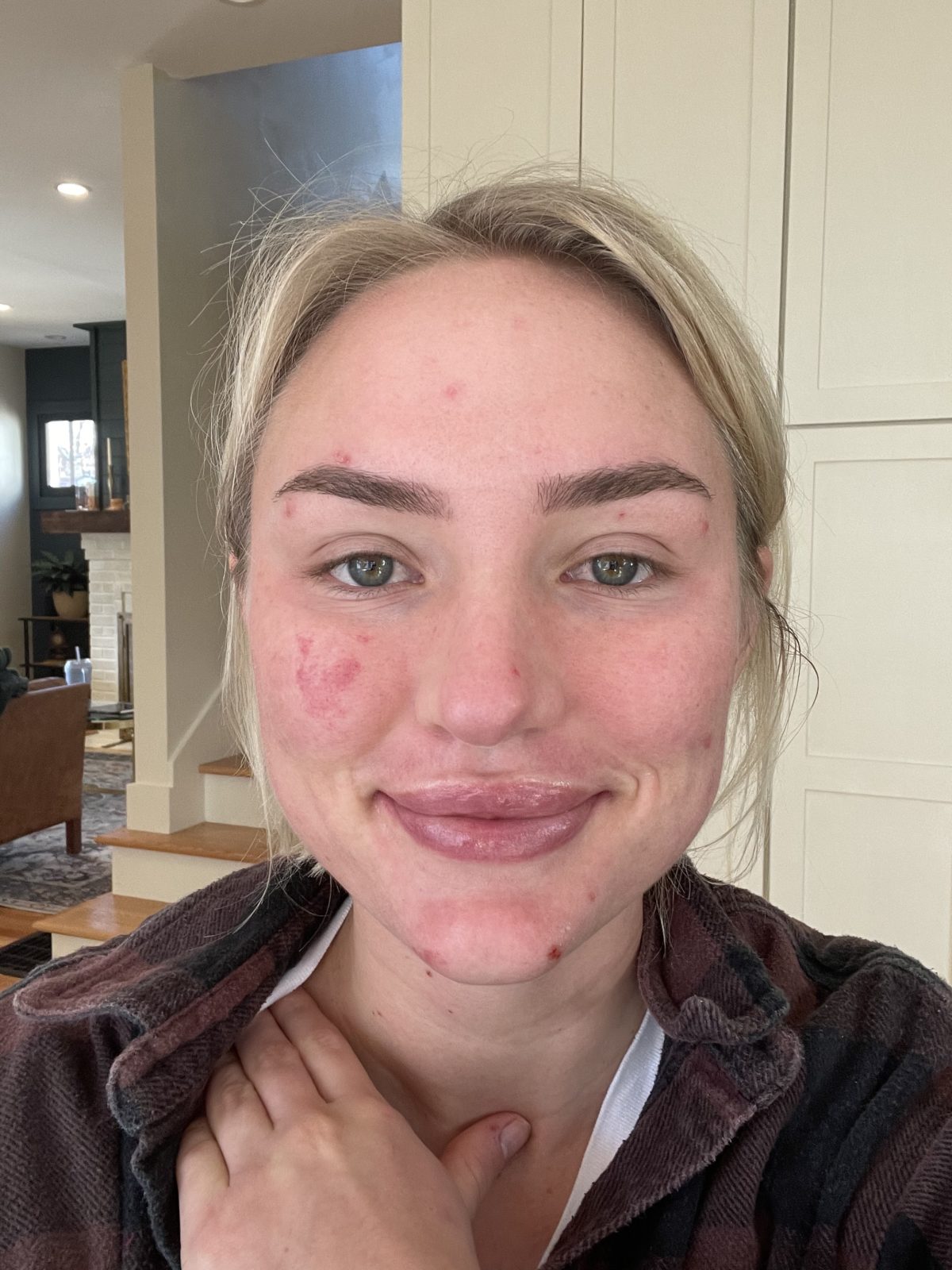 The Horrors Of Accutane: A Cautionary Tale