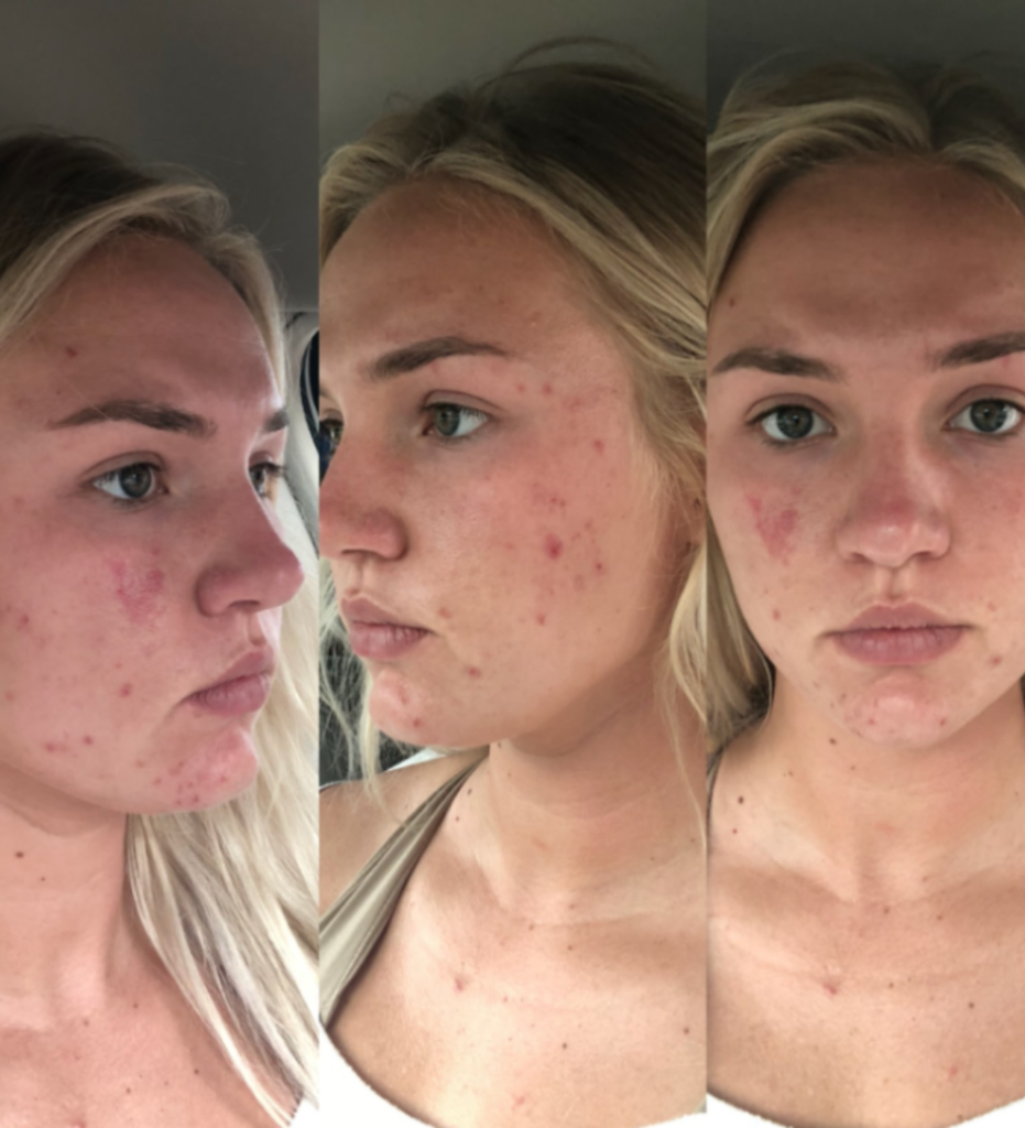 severe cystic acne accutane