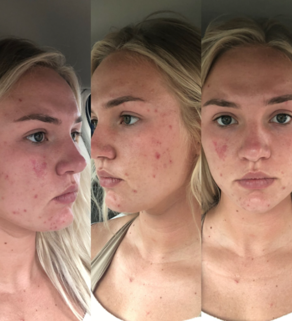 accutane journey malaysia