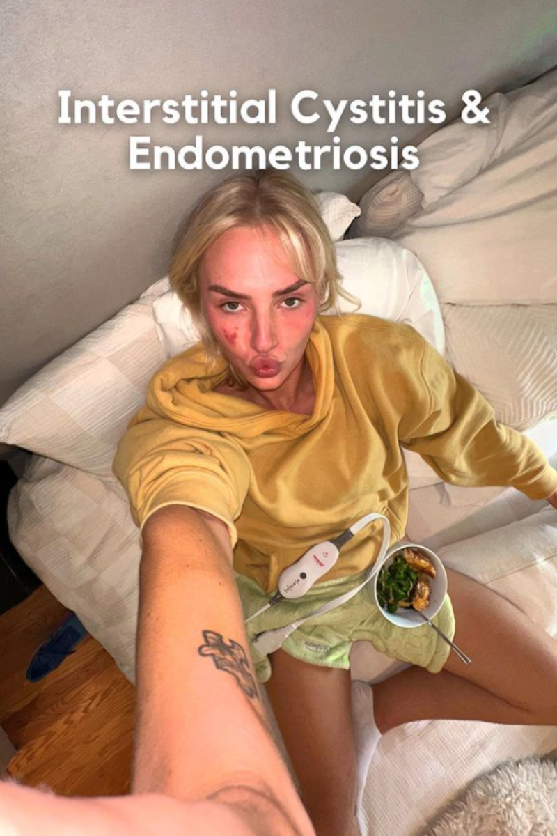 My endometriosis story